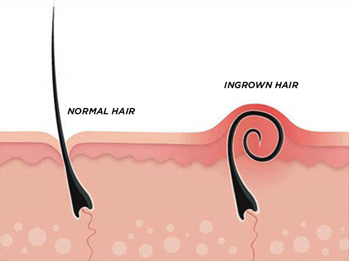 [S190057A-10] General Part Ingrown Hair