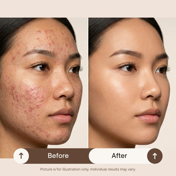 [S190011 - 90] Acne Clearance Facial Treatment - EFFECTIVE WAY to clear STUBBORN ACNE!