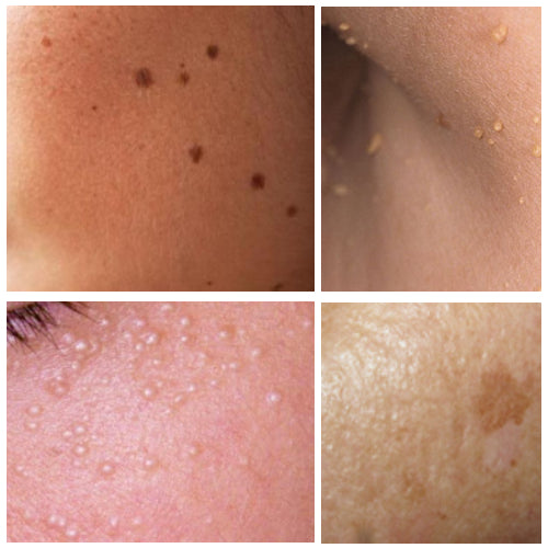 [ALA CARTE, Minimum $30] Zap Away Skin BLEMISHES! Say Good bye to Seborrheic keratosis, Solar Lentigo (aka Liver spots/ Age spots), Milia seeds (aka Oil seeds), Skin Tags, and Moles